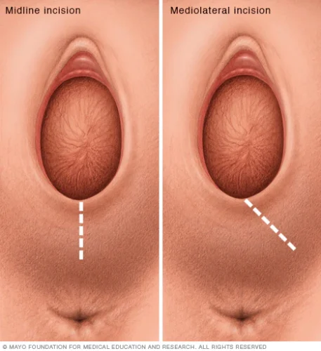 recuperación de una episiotomía: tipos de episiotomía
